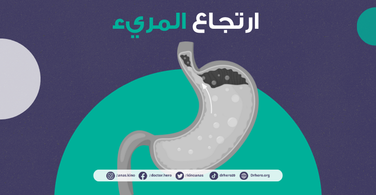 ارتجاع المريء