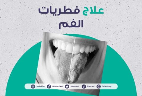 علاج فطريات الفم