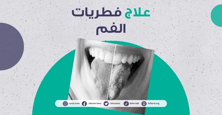 علاج فطريات الفم