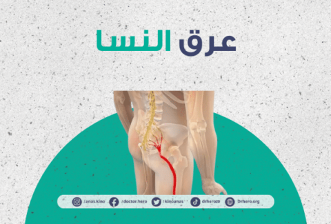 عرق النسا