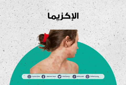 الإكزيما