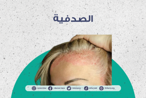 الصدفية