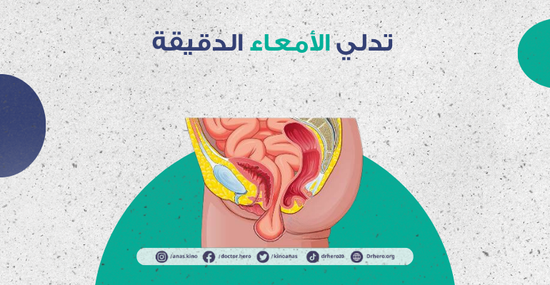 تدلي الأمعاء الدقيقة