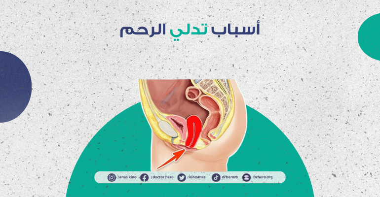 تدلي الرحم