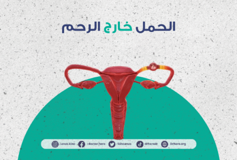 الحمل المنتبذ