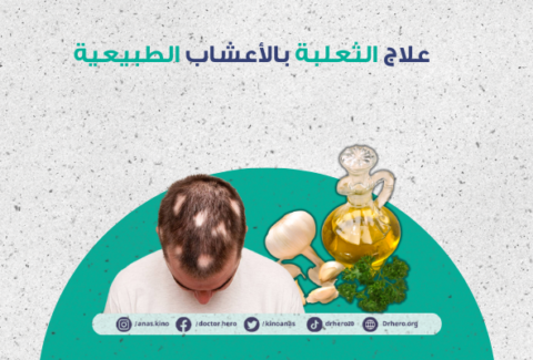 علاج الثعلبة بالأعشاب والطرق الطبيعية