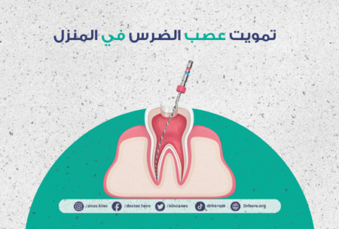 كيفية تمويت عصب الضرس في المنزل