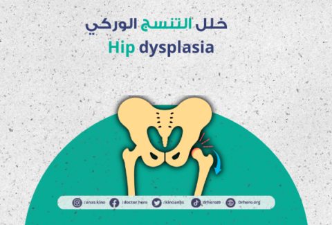 خلل التنسج الوركي