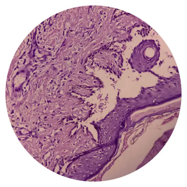 أسباب الإصابة بPemphigus