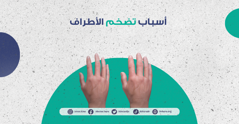 تضخم الأطراف