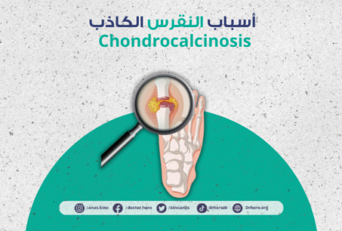 النقرس الكاذب