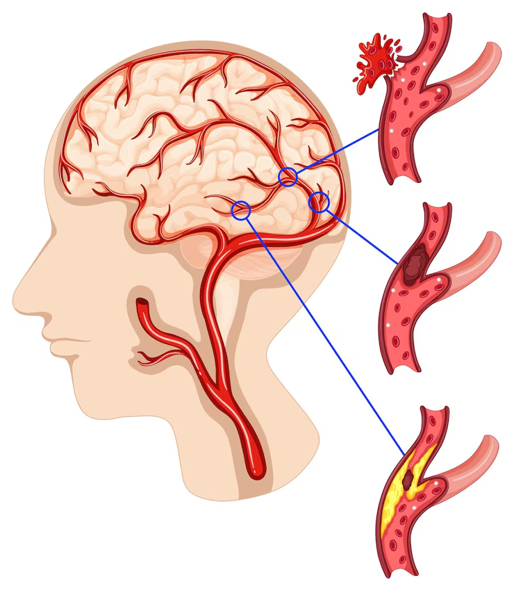 مسببات الVascular dementia
