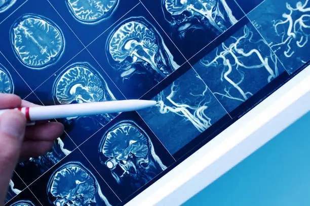 كيفية تشخيص الخرف الناتج عن مشكلات الأوعية الدموية