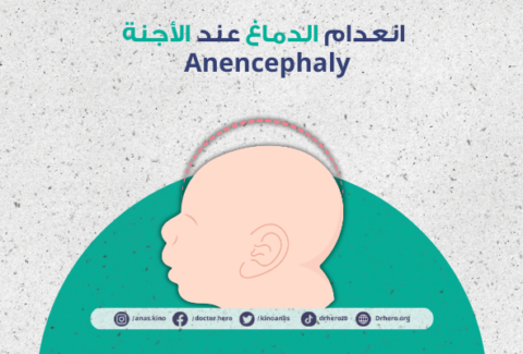 انعدام الدماغ