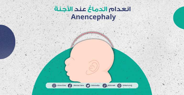 انعدام الدماغ