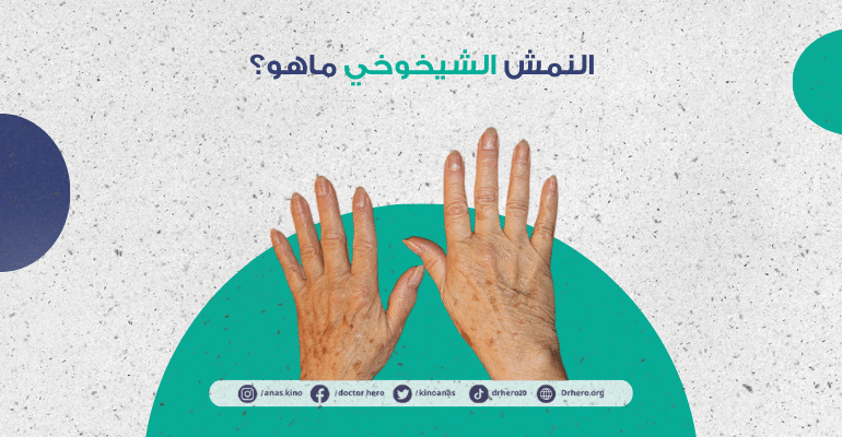 النمش الشيخوخي