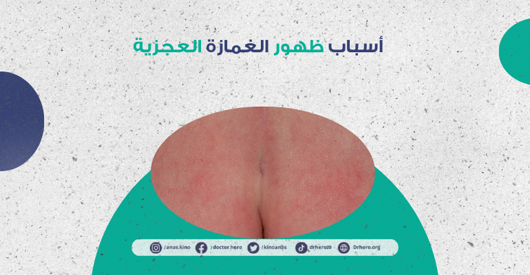 الغمازة العجزية