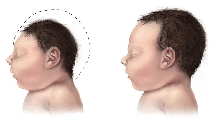 Anencephaly