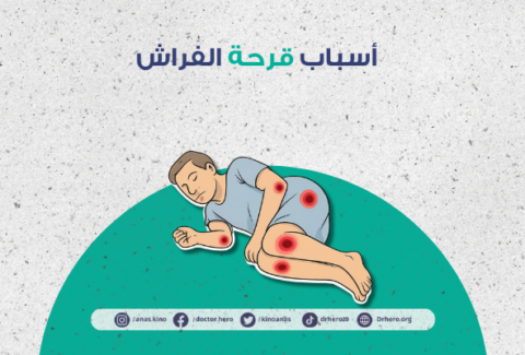 قرحة الضغط
