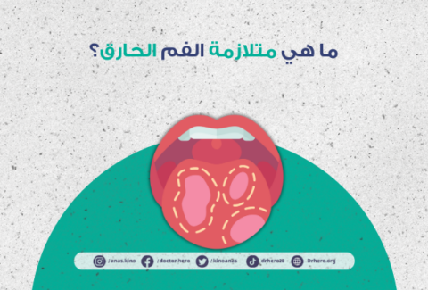 متلازمة الفم الحارق
