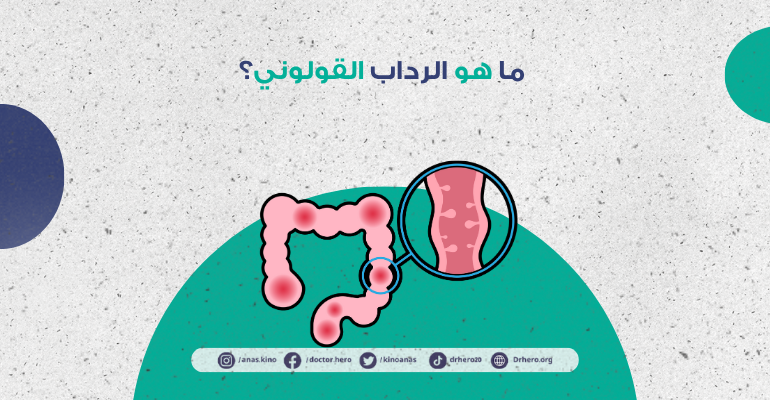 الرداب القولوني