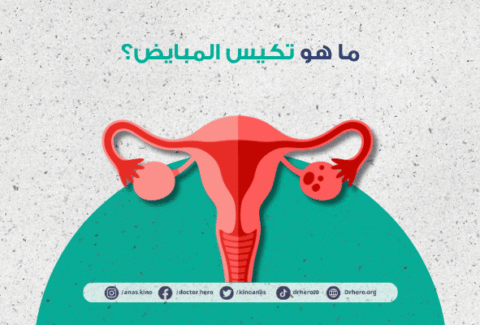 علامات تكيس المبايض المبكر