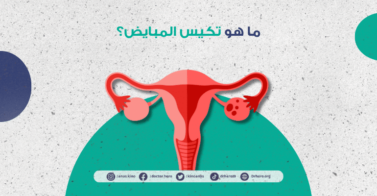 علامات تكيس المبايض المبكر