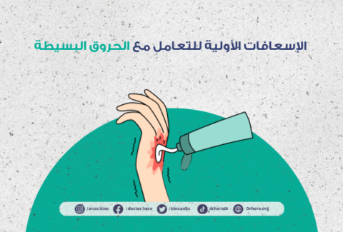 كيفية التعامل مع الحروق البسيطة