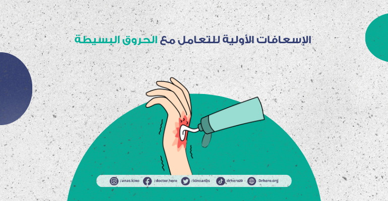 كيفية التعامل مع الحروق البسيطة