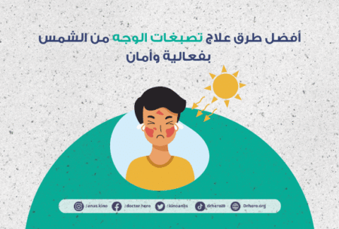 علاج تصبغات الوجه الناتجة عن أشعة الشمس