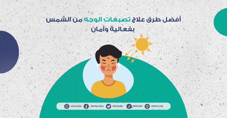 علاج تصبغات الوجه الناتجة عن أشعة الشمس