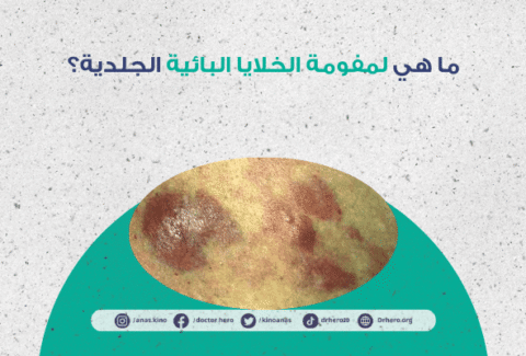 لمفومة الخلايا البائية الجلدية